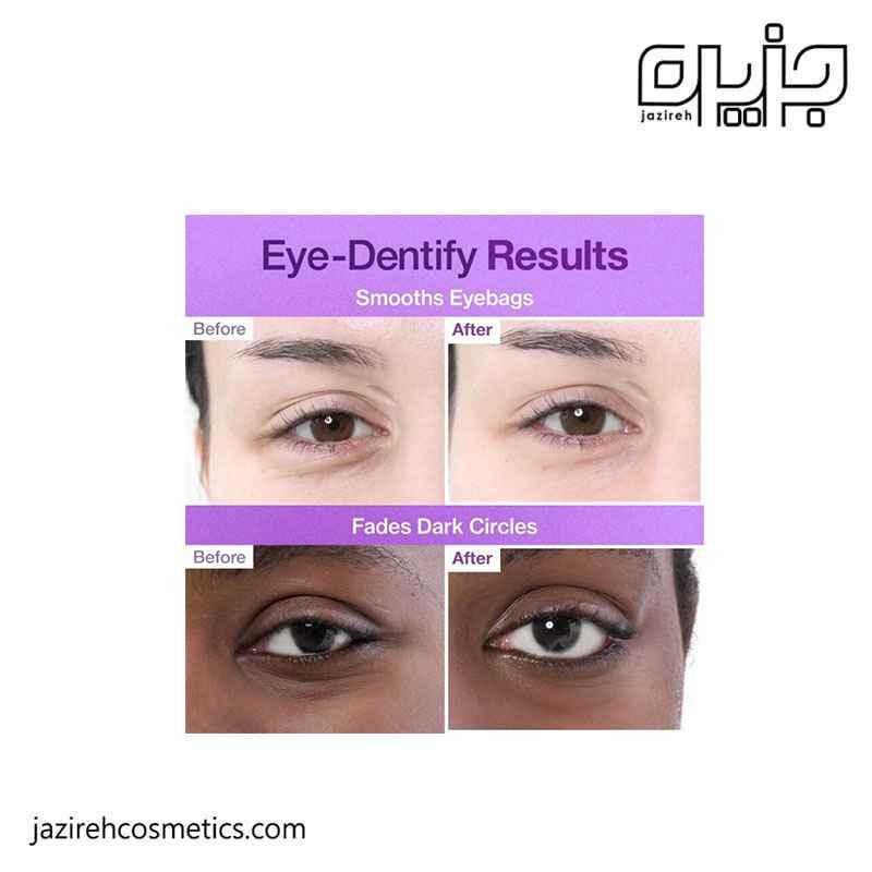 پچ زیر چشم نامبوزین